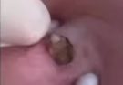 ST, An enormous blackhead in the ear